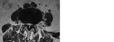 Identifying anatomical landmarks in a mild® patient