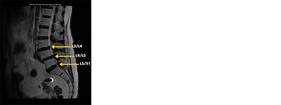 Identifying anatomical landmarks in a mild® patient