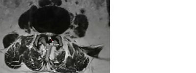 How to measure the ligamentum flavum in a mild® patient