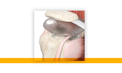 Stryker’s InSpace subacromial balloon spacer two-year, Level 1 randomized controlled clinical study published in the Journal of Bone and Joint Surgery