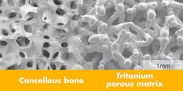 detail image of cancellous bone and Tritanium porous matrix