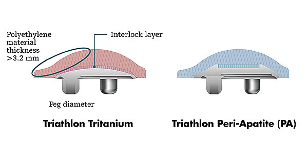 JR-Knee-Triathlon-Cementless-Hero-image02