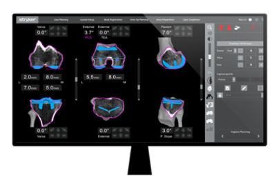 Mako Total Knee 2.0 planning page