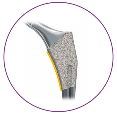 Total Hip Replacement, Anterior Approach (Accolade® II)