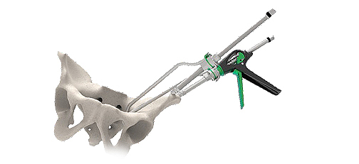 Linear Reduction Clamp enhanced