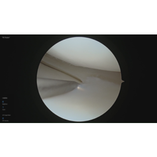 Lateral Meniscus Oblique Radial Tear (LMORT) Repair