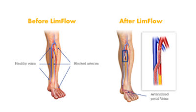 Before and After LimFlow