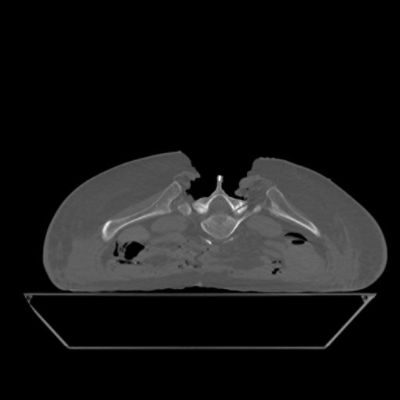 Lumbar Open w Fiducial Screws StandardmA (weight adpated) helical