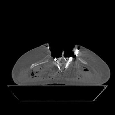 Lumbar Open w Screws Rods StandardmA helical