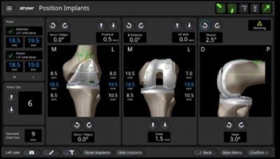 Mako RPS implant positioning software screen