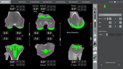 Achieving functional implant positioning with Mako Total Knee | Stryker