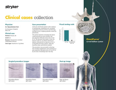 Clinical case demonstrating 68-year-old patient outcome with a history of osteoporosis using OmniCurve curved balloon system