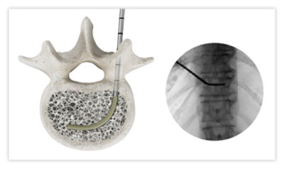 Step 1: Insert OmniCurve introducer with radiopaque sheath