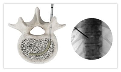 Step 2: Remove OmniCurve introducer, leaving sheath in place