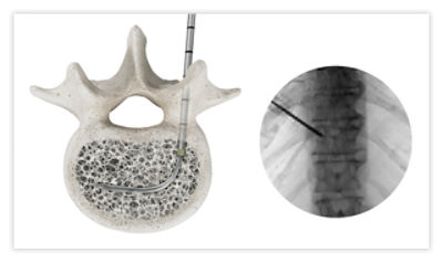 Step 4: Expose OmniCurve balloon by retracting the sheath