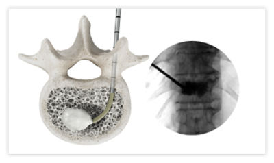 Step 7: Connect cement delivery device to sheath and inject cement