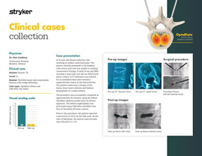 Clinical case demonstrating 76-year-old patient outcome with vertebral tumor and compression fracture using OptaBlate bone tumor ablation system