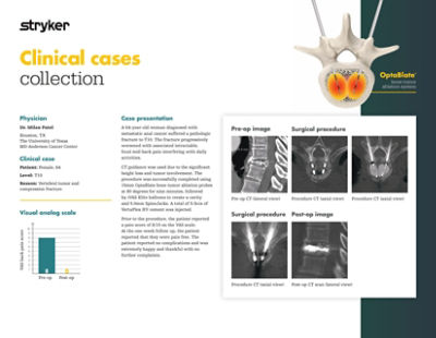 Clinical case demonstrating 64-year-old patient outcome with vertebral tumor and compression fracture using OptaBlate bone tumor ablation system