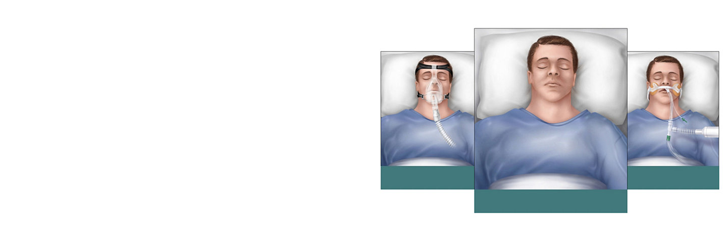 Image showing three illustrations of a patient at various stages of acuity, labeled "Vented", "Non-vented", and "Intubated".