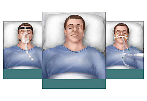 Image showing three illustrations of a patient at various stages of acuity, labeled "Vented", "Non-vented", and "Intubated".
