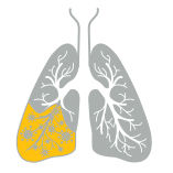 Icon depicting pneumonia in lungs