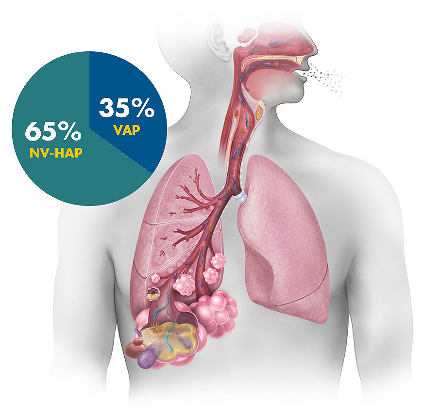 An illustration depicting pneumonia in human lungs with a pie chart callout of pneumonia types that reads 65% NV-HAP and 35% VAP