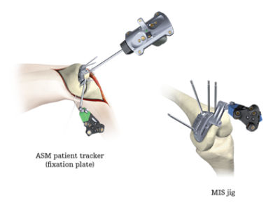 Ortho Guidance express knee software | Stryker