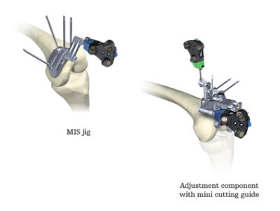 Ortho Guidance precision knee software | Stryker