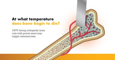 https://media-assets.stryker.com/is/image/stryker/Osteonecrosis%20Graphic?$max_width_1440$