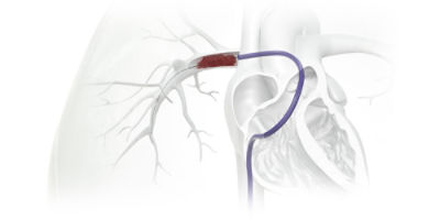 FlowTriever clot removal