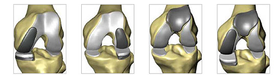 Restoris MCK implants on knee models