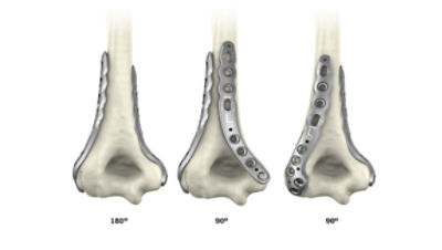 Humeral plate angles