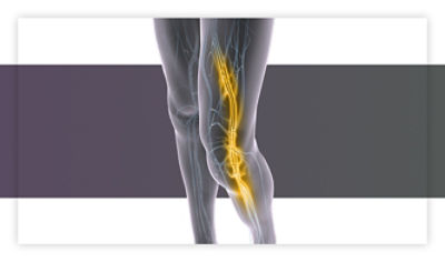 Deep vein thrombosis