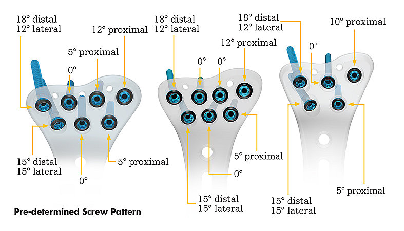 Pre-determined screw pattern