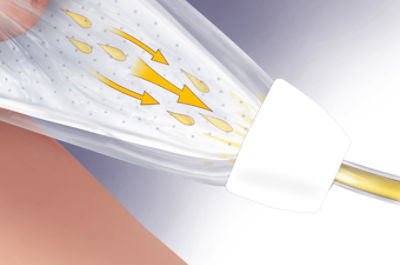 Medical illustration of urine being diverted through the PrimoFit Flow external urine management device
