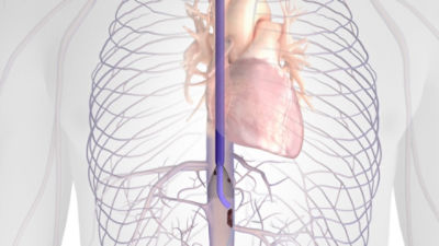 Protrieve and T20 Curve in anatomy