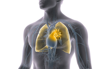 Pulmonary Embolism (PE) Thrombectomy