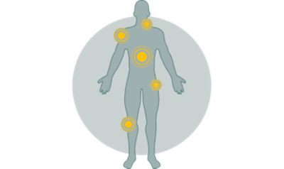 Radiofrequency-nerve-ablation_icon_640x380