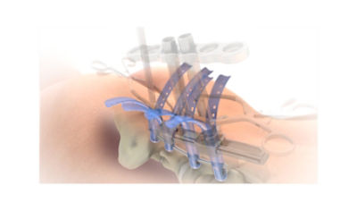 Serengeti Complex Minimally Invasive