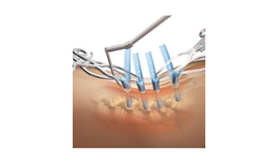 Serengeti Minimally Invasive