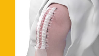 A New Form of Noninvasive Wound Closure With a Surgical Zipper