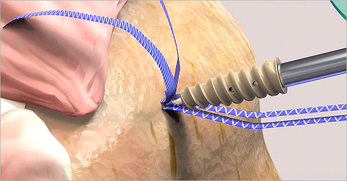 Guiding suture path