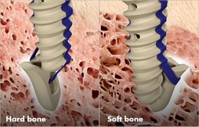 Proprietary decoupled eyelet: Hard bone, Soft bone