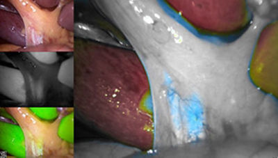 Laparoscopic cholecystectomy