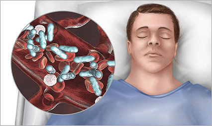 Illustration of a non-ventilated patient in a hospital bed with an inset illustration depicting sepsis.