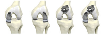 Restoris MCK implants on knee models