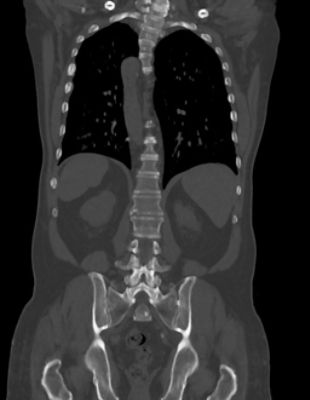 Spine_coronal
