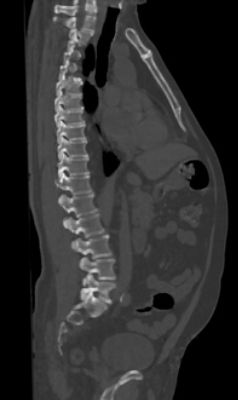 Spine_sagittal