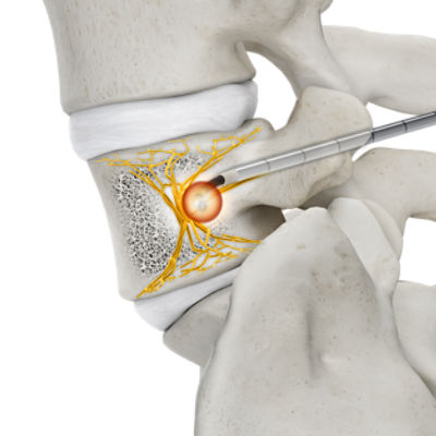 OptaBlate-BVN-ablation-vertebral-body