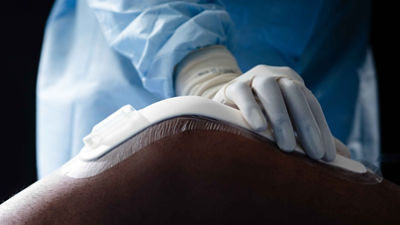 Surgeon placing NPSeal on patient